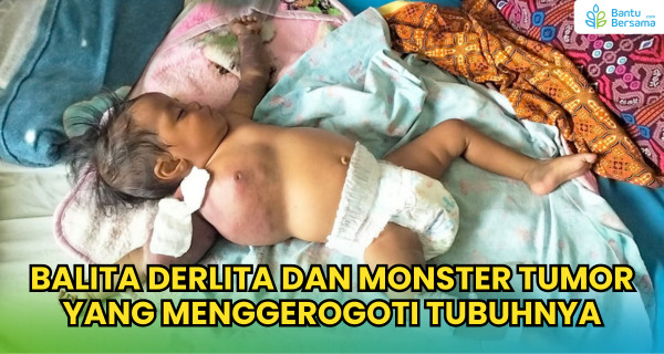 Derlita, Bayi 9 Bulan Melawan Tumor Langka Yang Mengancam Nyawanya