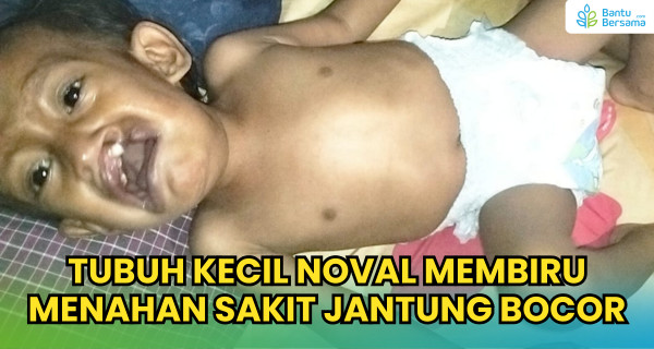 Tubuh Kecil Noval Membiru Menahan Sakit Jantung Bocor