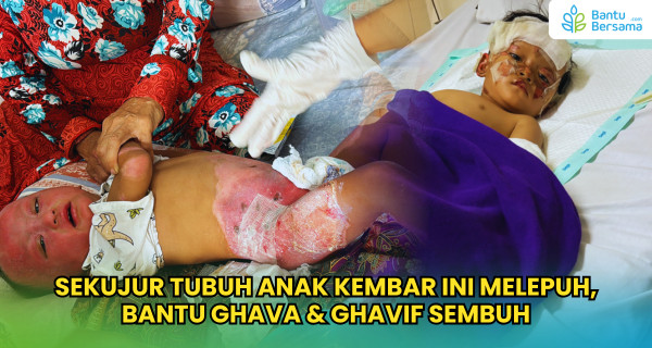 Sekujur Tubuh Anak Kembar Ini Melepuh, Bantu Ghava & Ghavif Sembuh