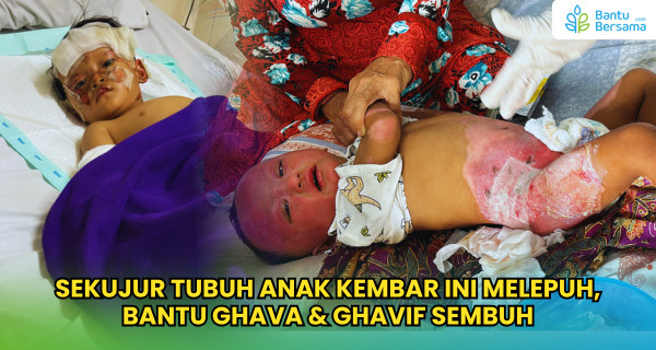 Sekujur Tubuh Anak Kembar Ini Melepuh, Bantu Ghava & Ghavif Sembuh
