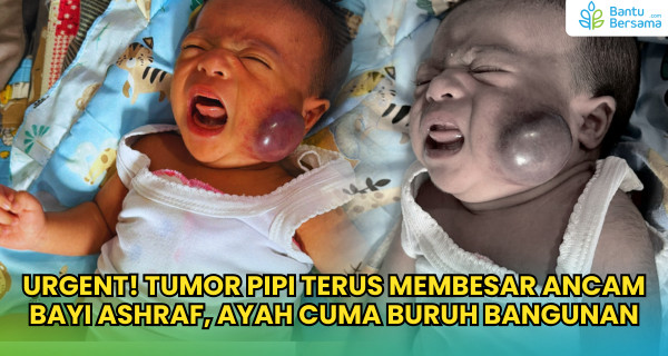 Tumor Pipi Terus Membesar Ancam Bayi Ashraf, Ayah Cuma Buruh Bangunan
