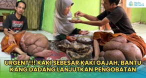 Kang Dadang, Hidup Dengan Kaki Membesar Akibat Penyakit Lymphoma