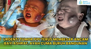 Tumor Pipi Terus Membesar Ancam Bayi Ashraf, Ayah Cuma Buruh Bangunan